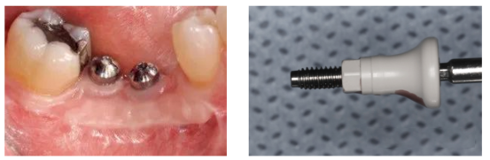 愈合机台怎么识别型号愈合基台的定义、分类、特点和临床选择,一文详解_新闻资讯_第13张_活检穿刺产品网 愈合机台怎么识别型号愈合基台的定义、分类、特点和临床选择,一文详解_https://www.jmylbn.com_新闻资讯_第13张
