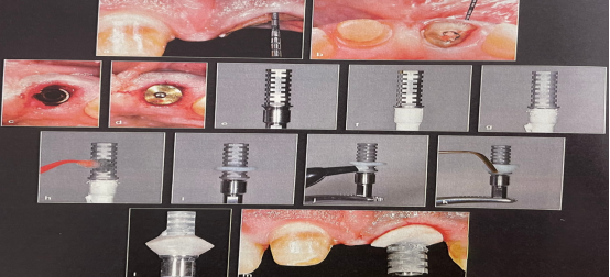 愈合机台怎么识别型号愈合基台的定义、分类、特点和临床选择，一文详解_https://www.jmylbn.com_新闻资讯_第15张