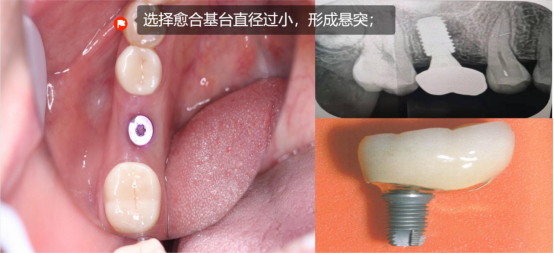 愈合机台怎么识别型号愈合基台的定义、分类、特点和临床选择,一文详解_新闻资讯_第21张_活检穿刺产品网 愈合机台怎么识别型号愈合基台的定义、分类、特点和临床选择,一文详解_https://www.jmylbn.com_新闻资讯_第21张