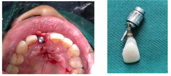 愈合机台怎么识别型号愈合基台的定义、分类、特点和临床选择,一文详解_新闻资讯_第14张_活检穿刺产品网 愈合机台怎么识别型号愈合基台的定义、分类、特点和临床选择,一文详解_https://www.jmylbn.com_新闻资讯_第14张