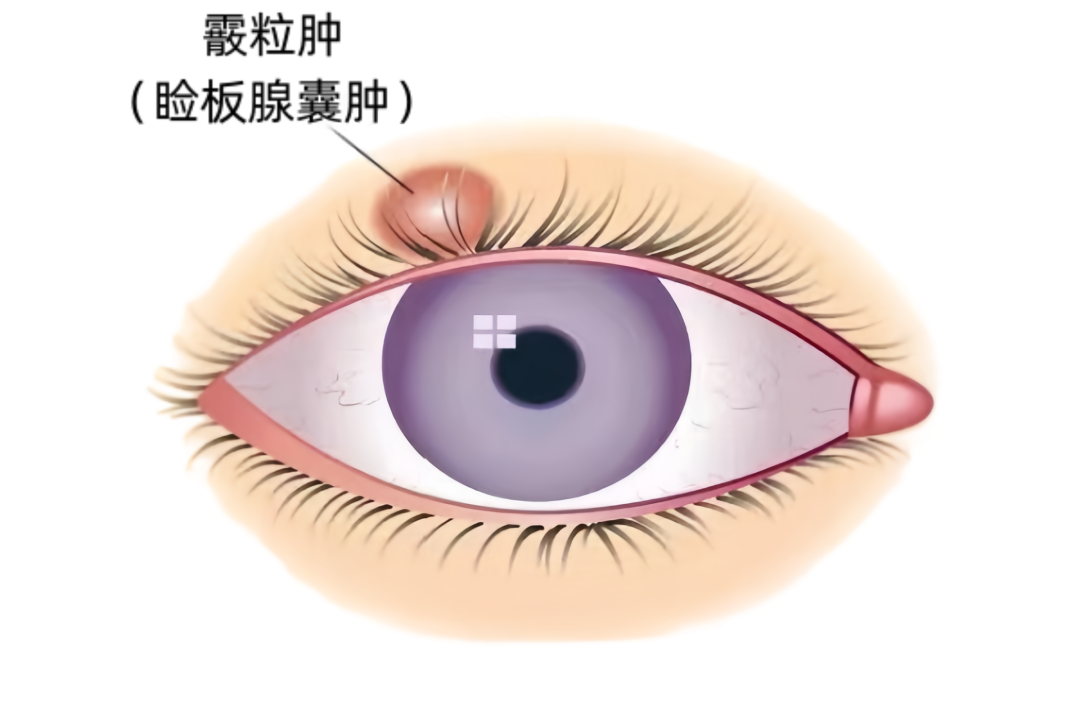 霰粒肿（睑板腺囊肿）