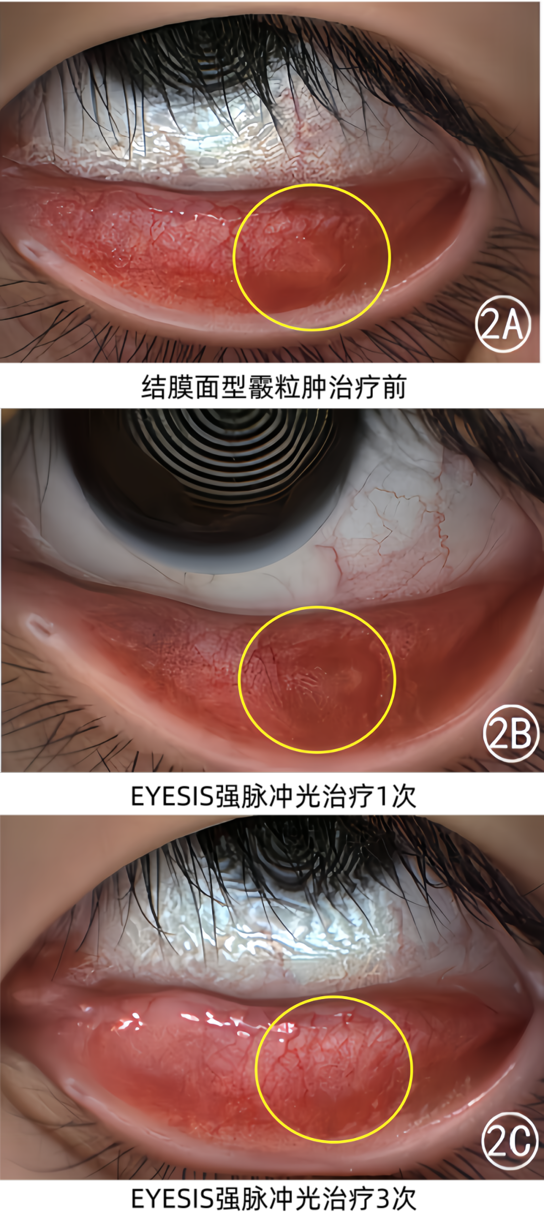 结膜面型霰粒肿强脉冲光治疗前后效果对比