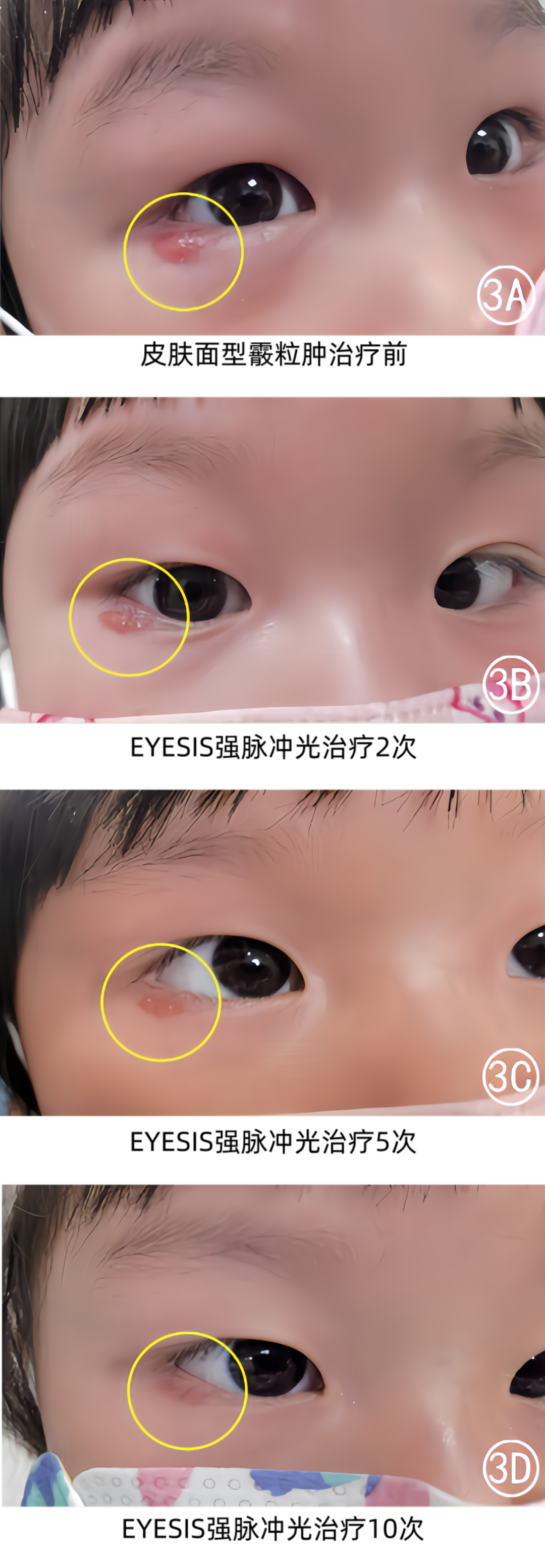 皮肤面型霰粒肿强脉冲光治疗前后效果对比