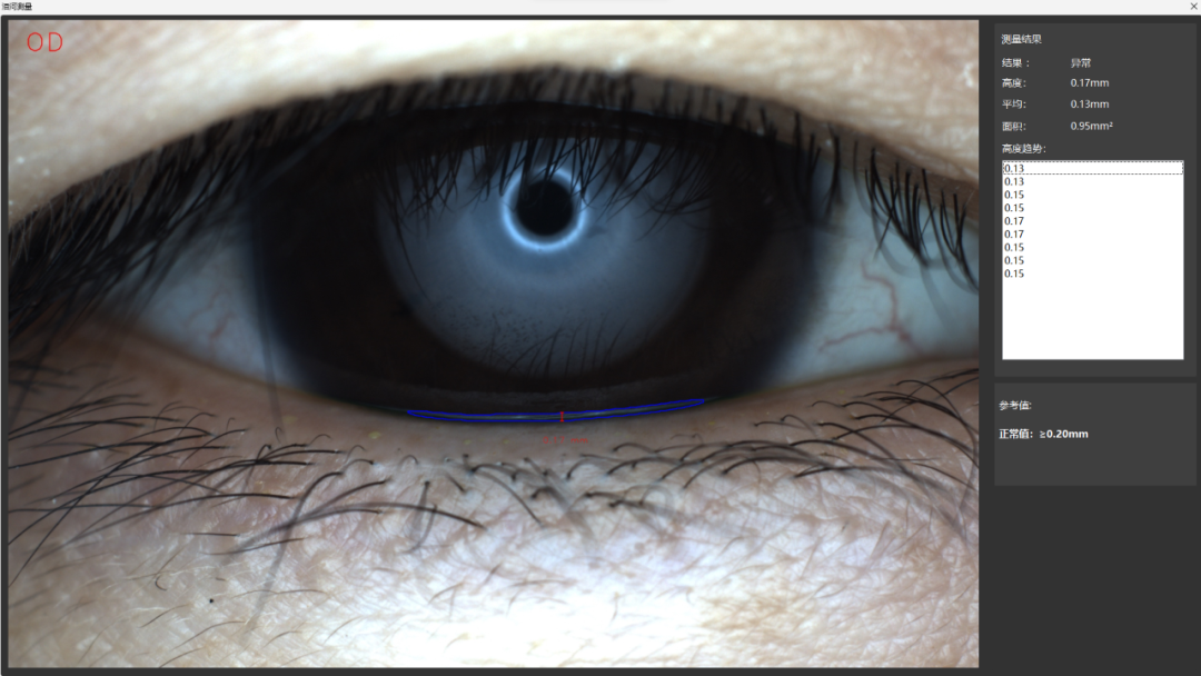 EYESIS干眼综合检查仪泪河高度