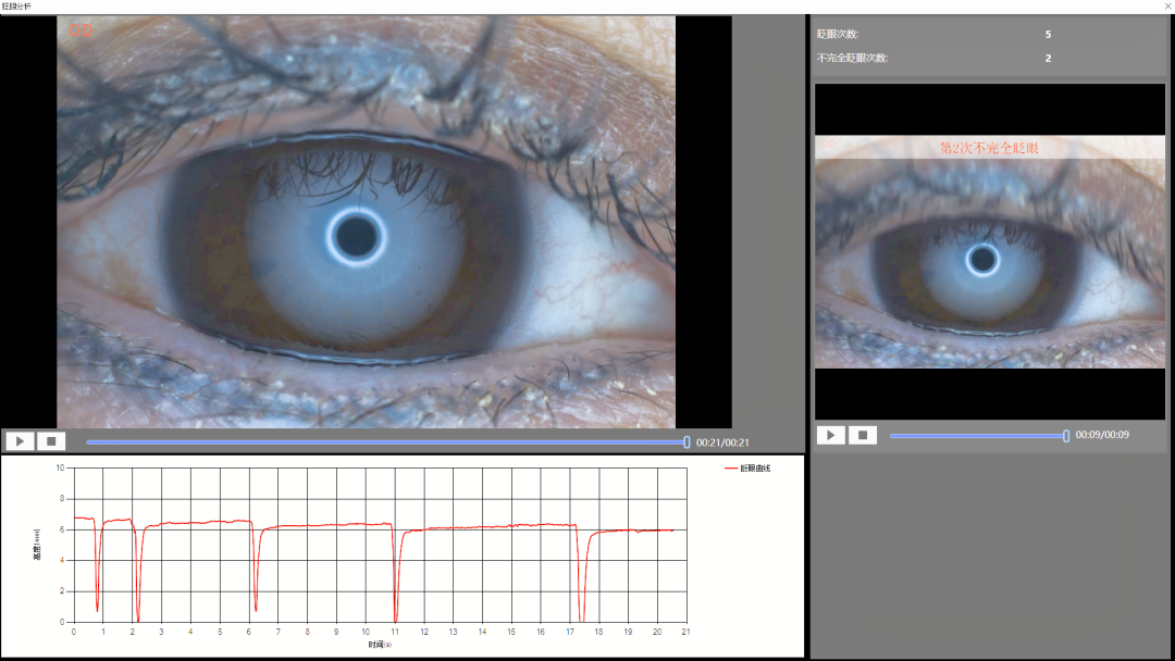 眨眼瞬目状态检查