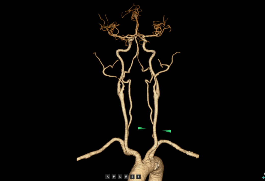 联影有哪些CT我院放射科再添“硬核“利器—联影60排120层螺旋CT机_https://www.jmylbn.com_新闻资讯_第26张