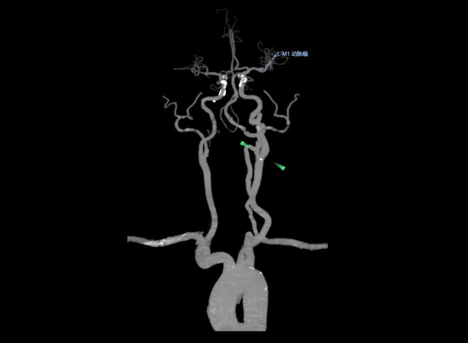 联影有哪些CT我院放射科再添“硬核“利器—联影60排120层螺旋CT机_https://www.jmylbn.com_新闻资讯_第25张