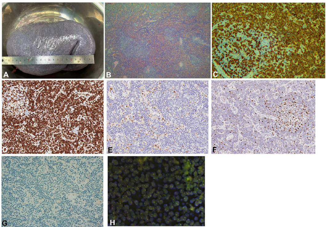 pl在医学中是什么意思文章发表｜ NGS助力脾弥漫性红髓小B细胞淋巴瘤（SDRPL）的分子诊断_https://www.jmylbn.com_新闻资讯_第4张
