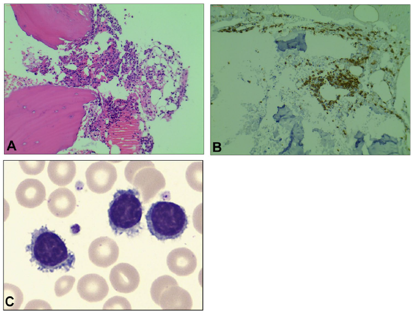 pl在医学中是什么意思文章发表｜ NGS助力脾弥漫性红髓小B细胞淋巴瘤（SDRPL）的分子诊断_https://www.jmylbn.com_新闻资讯_第5张