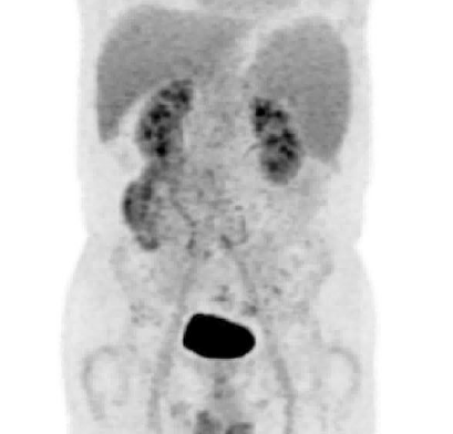 pl在医学中是什么意思文章发表｜ NGS助力脾弥漫性红髓小B细胞淋巴瘤（SDRPL）的分子诊断_https://www.jmylbn.com_新闻资讯_第3张