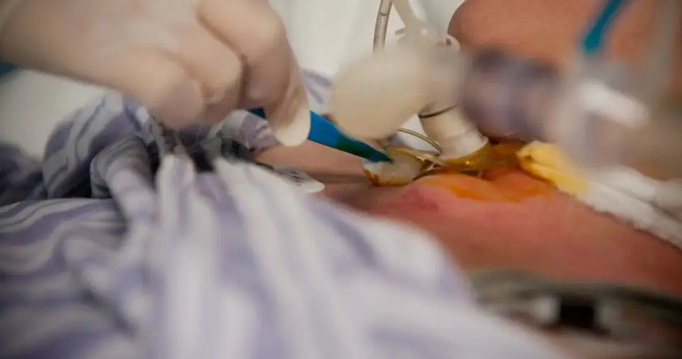 气管套管怎么换药专业级护理指南丨气切后应该如何换药？_https://www.jmylbn.com_新闻资讯_第10张