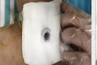气管套管怎么换药专业级护理指南丨气切后应该如何换药？_https://www.jmylbn.com_新闻资讯_第13张