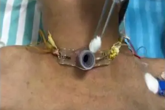 气管套管怎么换药专业级护理指南丨气切后应该如何换药？_https://www.jmylbn.com_新闻资讯_第14张