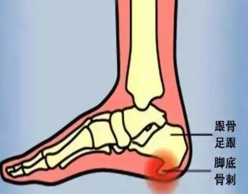 医讯怎么用【医讯】跟骨骨刺不用怕，微创技术帮到您_https://www.jmylbn.com_新闻资讯_第8张