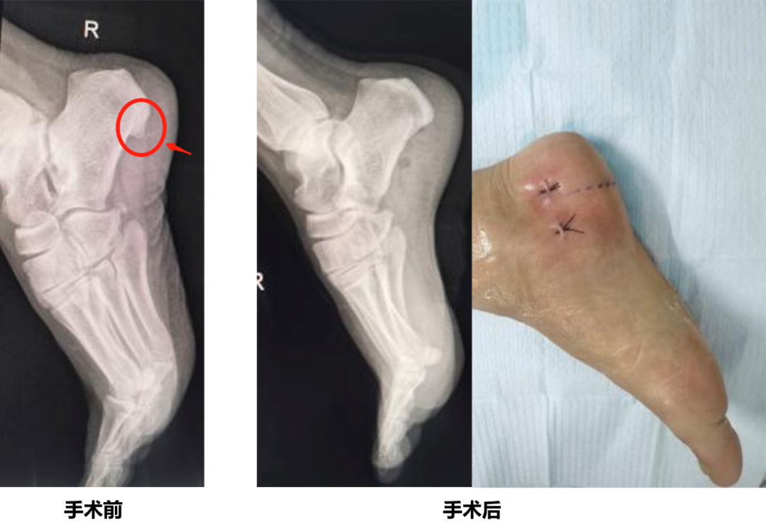 医讯怎么用【医讯】跟骨骨刺不用怕，微创技术帮到您_https://www.jmylbn.com_新闻资讯_第7张