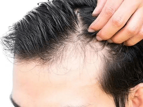 掉发严重，先别植发