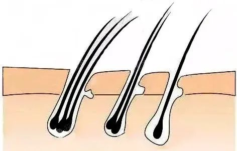 毛囊的六大病态状况