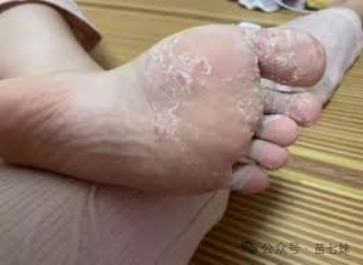 解决顽固性皮肤问题！苗族秘方助力，天然中药治脚气、手足癣等困扰