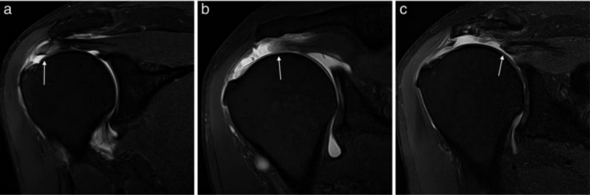 为什么会有单关节器械关节镜下肩袖修复：单排 vs 双排缝合，如何选择？_https://www.jmylbn.com_新闻资讯_第6张