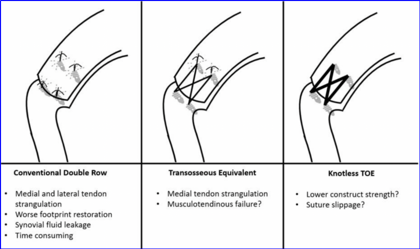 为什么会有单关节器械关节镜下肩袖修复：单排 vs 双排缝合，如何选择？_https://www.jmylbn.com_新闻资讯_第14张