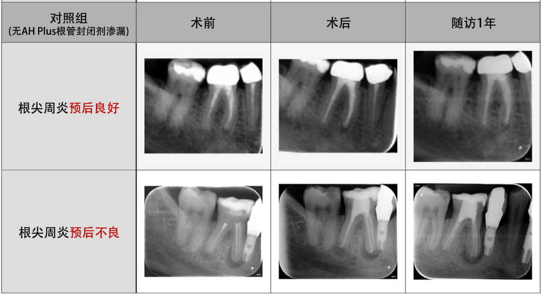 告诉患者，这种“超充”不影响根尖周炎愈合-搜博