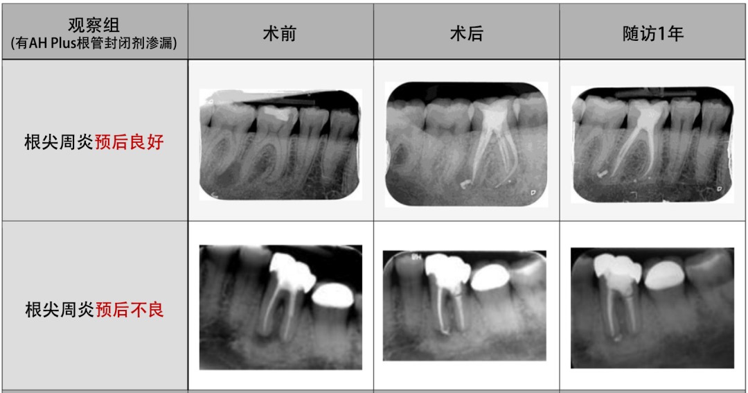告诉患者，这种“超充”不影响根尖周炎愈合-搜博