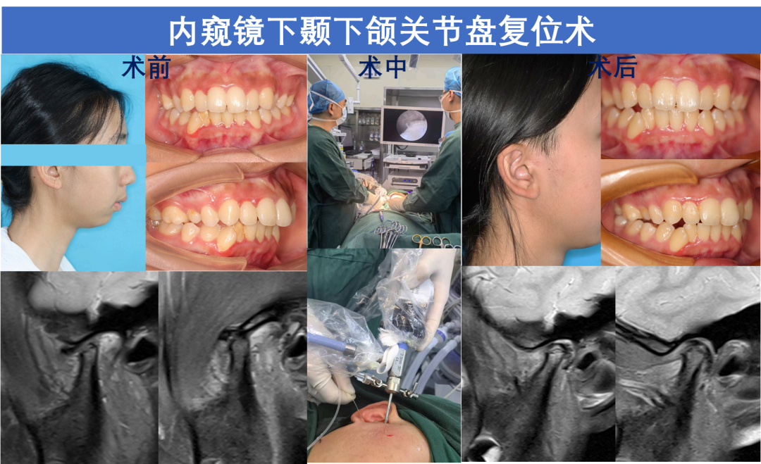 口腔内窥镜怎么安装吉林大学口腔医院成功实施首例腮腺结石微创取石术，在内窥镜微创治疗领域迈向新台阶_https://www.jmylbn.com_新闻资讯_第4张