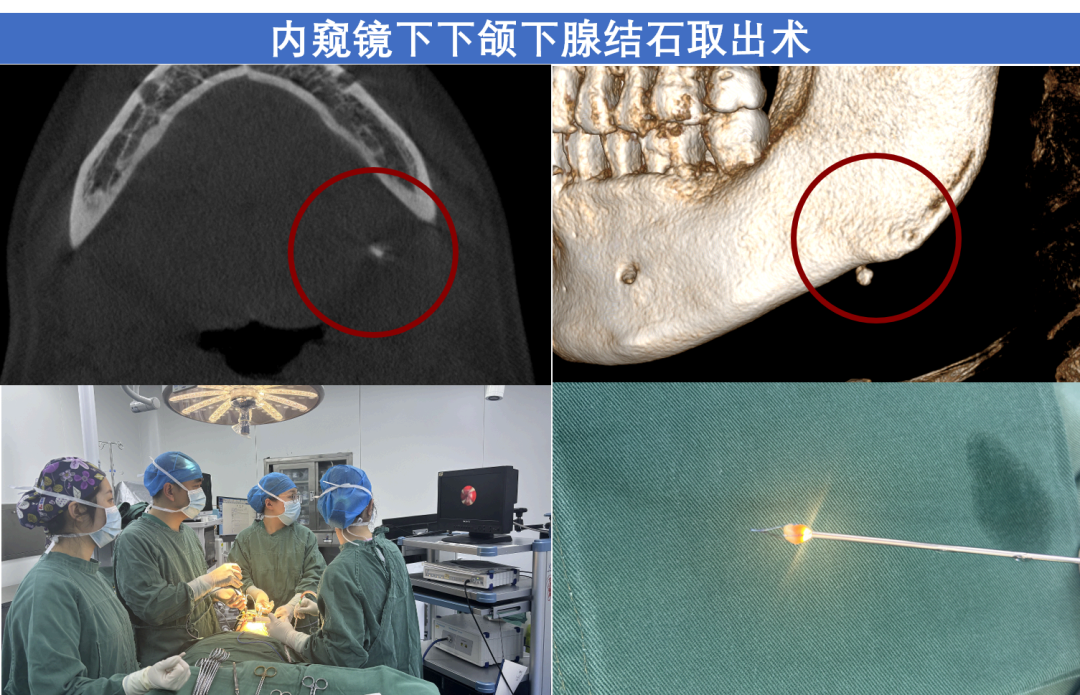 口腔内窥镜怎么安装吉林大学口腔医院成功实施首例腮腺结石微创取石术，在内窥镜微创治疗领域迈向新台阶_https://www.jmylbn.com_新闻资讯_第3张