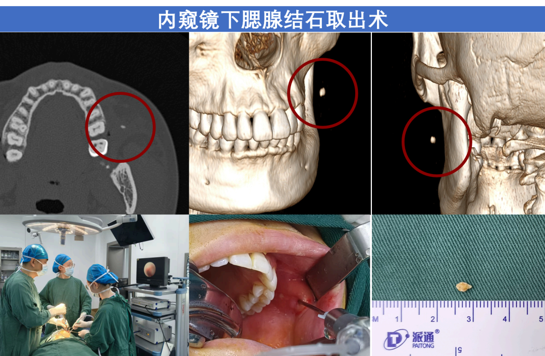 口腔内窥镜怎么安装吉林大学口腔医院成功实施首例腮腺结石微创取石术，在内窥镜微创治疗领域迈向新台阶_https://www.jmylbn.com_新闻资讯_第2张