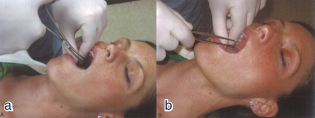 气管插管怎么取出口腔诊疗过程中误吸器械的预防及处理_https://www.jmylbn.com_新闻资讯_第10张