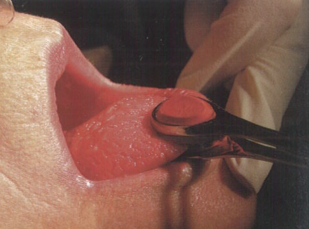 气管插管怎么取出口腔诊疗过程中误吸器械的预防及处理_https://www.jmylbn.com_新闻资讯_第11张