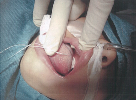 气管插管怎么取出口腔诊疗过程中误吸器械的预防及处理_https://www.jmylbn.com_新闻资讯_第6张