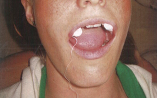 气管插管怎么取出口腔诊疗过程中误吸器械的预防及处理_https://www.jmylbn.com_新闻资讯_第13张