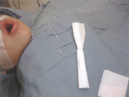 气管插管怎么取出口腔诊疗过程中误吸器械的预防及处理_https://www.jmylbn.com_新闻资讯_第12张