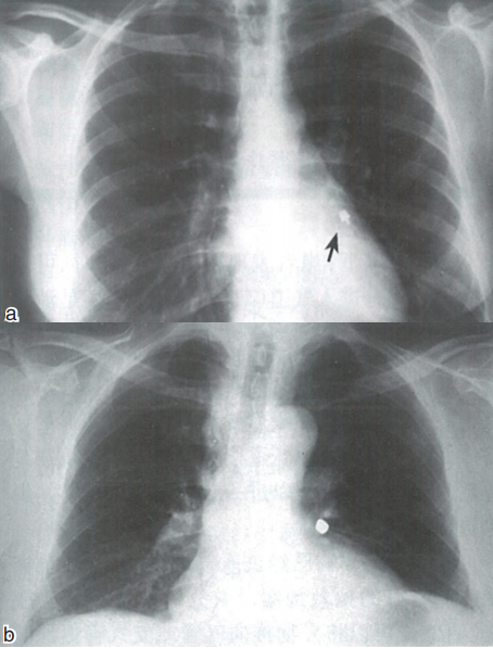 气管插管怎么取出口腔诊疗过程中误吸器械的预防及处理_https://www.jmylbn.com_新闻资讯_第15张