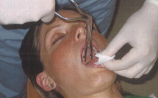 气管插管怎么取出口腔诊疗过程中误吸器械的预防及处理_https://www.jmylbn.com_新闻资讯_第9张