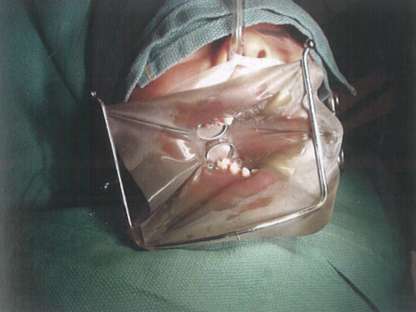 气管插管怎么取出口腔诊疗过程中误吸器械的预防及处理_https://www.jmylbn.com_新闻资讯_第5张