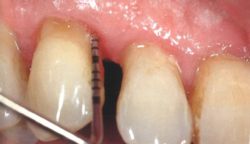 口腔激光怎么治疗“难治性”牙周炎的激光辅助治疗_https://www.jmylbn.com_新闻资讯_第3张