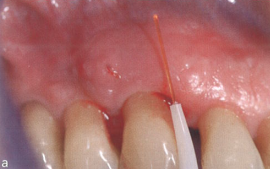 口腔激光怎么治疗“难治性”牙周炎的激光辅助治疗_https://www.jmylbn.com_新闻资讯_第11张