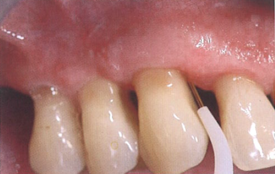 口腔激光怎么治疗“难治性”牙周炎的激光辅助治疗_https://www.jmylbn.com_新闻资讯_第7张