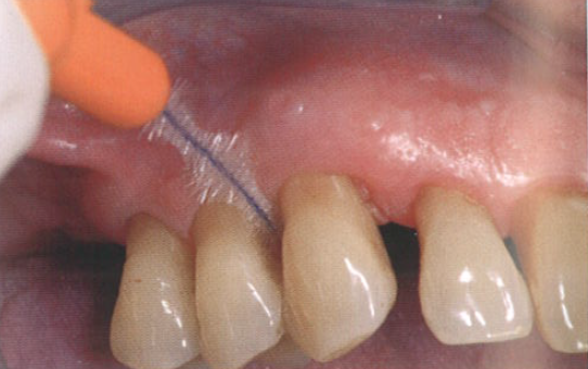 口腔激光怎么治疗“难治性”牙周炎的激光辅助治疗_https://www.jmylbn.com_新闻资讯_第16张