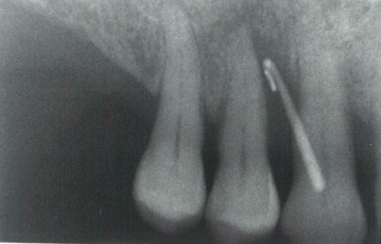 口腔激光怎么治疗“难治性”牙周炎的激光辅助治疗_https://www.jmylbn.com_新闻资讯_第10张