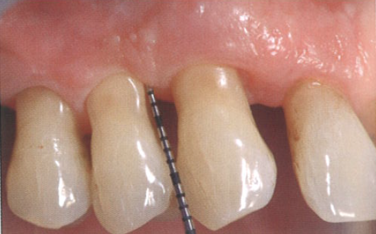 口腔激光怎么治疗“难治性”牙周炎的激光辅助治疗_https://www.jmylbn.com_新闻资讯_第15张