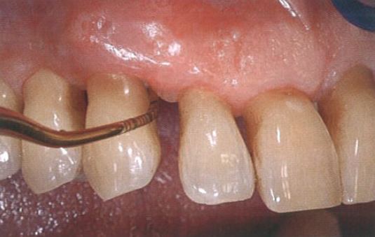 口腔激光怎么治疗“难治性”牙周炎的激光辅助治疗_https://www.jmylbn.com_新闻资讯_第13张