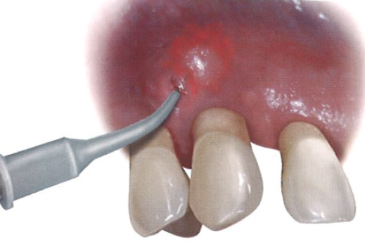 口腔激光怎么治疗“难治性”牙周炎的激光辅助治疗_https://www.jmylbn.com_新闻资讯_第9张