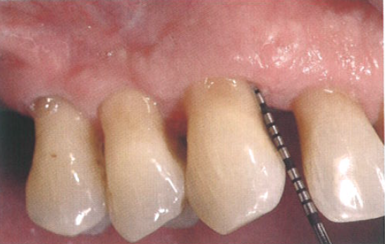 口腔激光怎么治疗“难治性”牙周炎的激光辅助治疗_https://www.jmylbn.com_新闻资讯_第5张