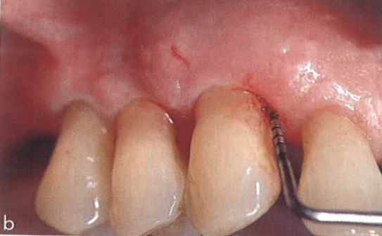 口腔激光怎么治疗“难治性”牙周炎的激光辅助治疗_https://www.jmylbn.com_新闻资讯_第12张