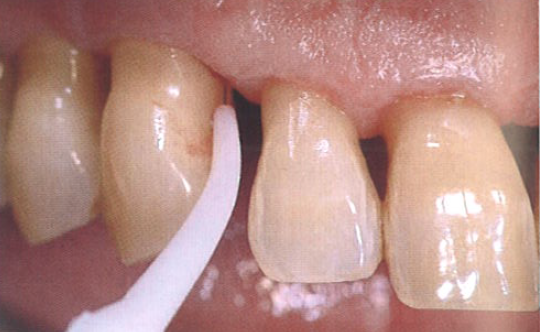 口腔激光怎么治疗“难治性”牙周炎的激光辅助治疗_https://www.jmylbn.com_新闻资讯_第6张