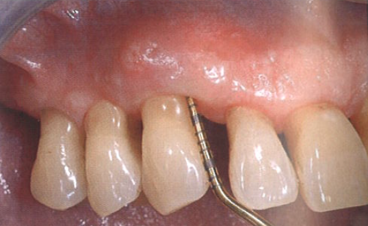 口腔激光怎么治疗“难治性”牙周炎的激光辅助治疗_https://www.jmylbn.com_新闻资讯_第14张