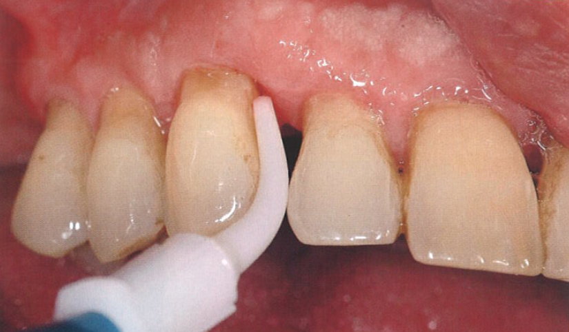 口腔激光怎么治疗“难治性”牙周炎的激光辅助治疗_https://www.jmylbn.com_新闻资讯_第4张